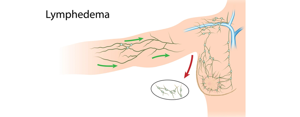 Why Early Lymphedema Detection Matters